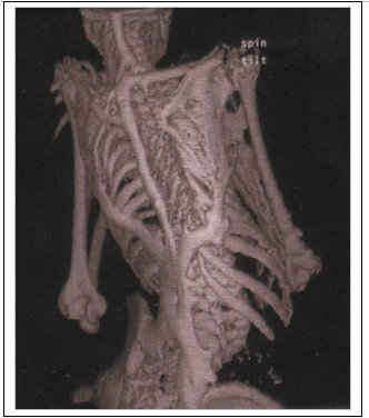 Radiographie, maladie de FLOP