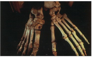 Comparaison des os du pied, homme et Chimpanzée