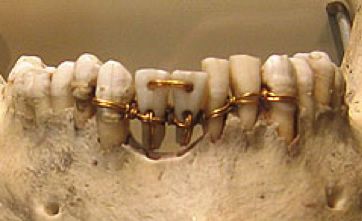 Dentition d'une momie égyptienne