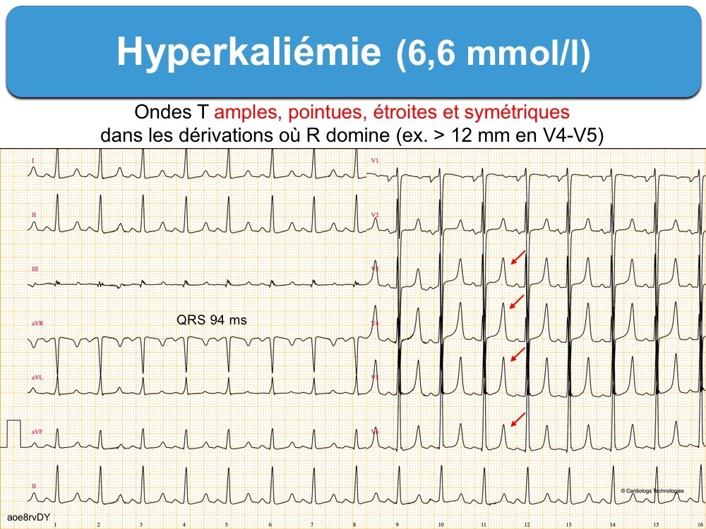 Cours n°2 - Electrocardiogramme (ECG) 6p6b