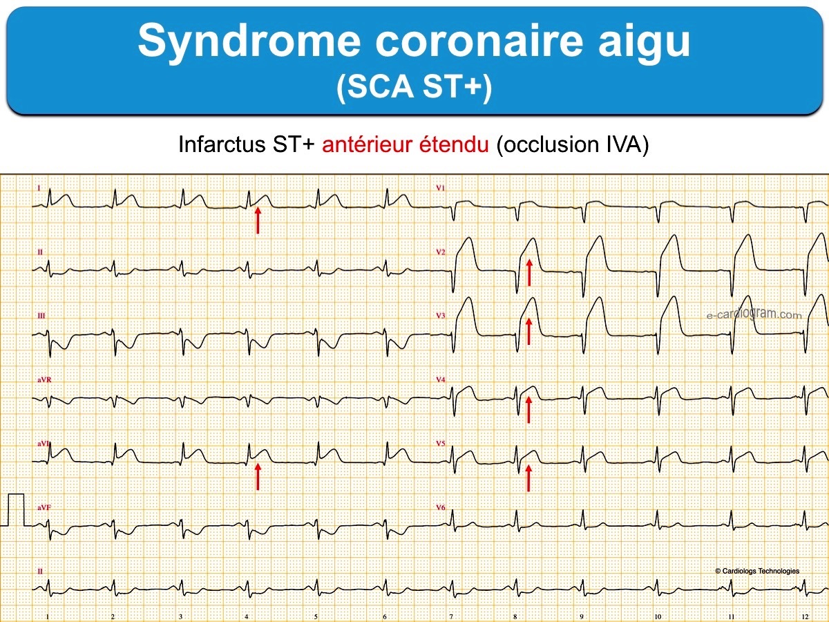 Cours n°2 - Electrocardiogramme (ECG) 7vw0