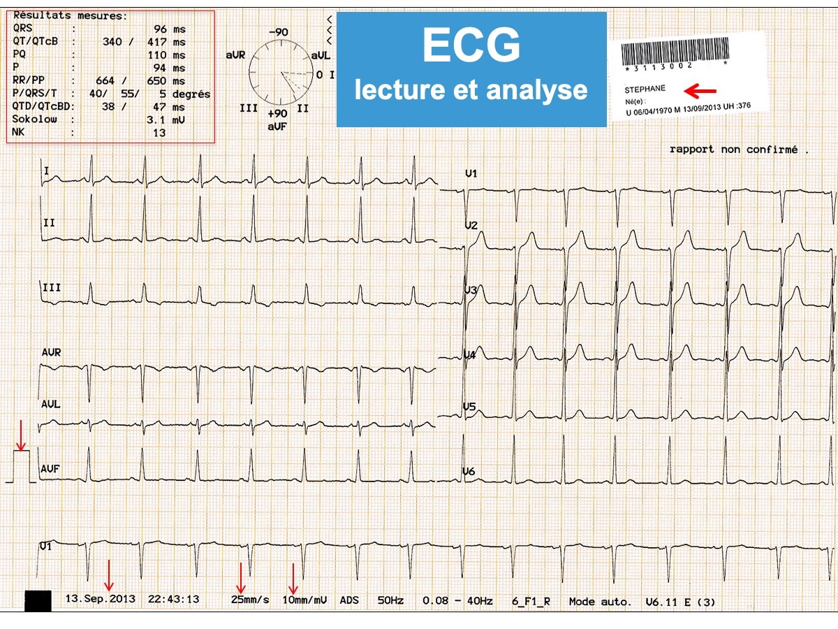 Cours n°2 - Electrocardiogramme (ECG) Epwv