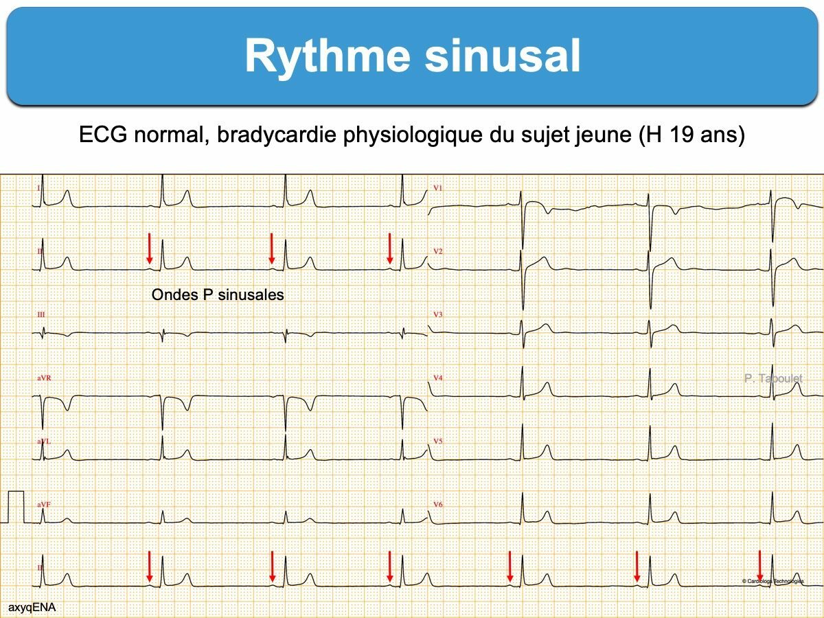 Cours n°2 - Electrocardiogramme (ECG) Imlb