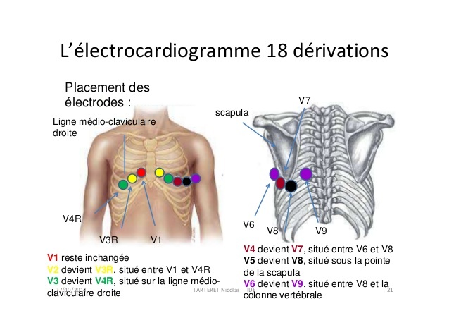 Cours n°2 - Electrocardiogramme (ECG) Otfq