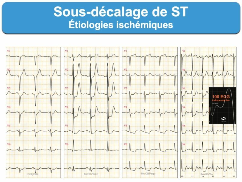 Cours n°2 - Electrocardiogramme (ECG) Pf32