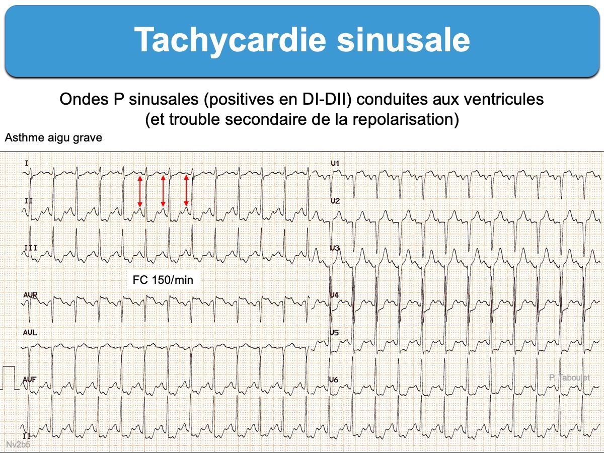 Cours n°2 - Electrocardiogramme (ECG) Q523