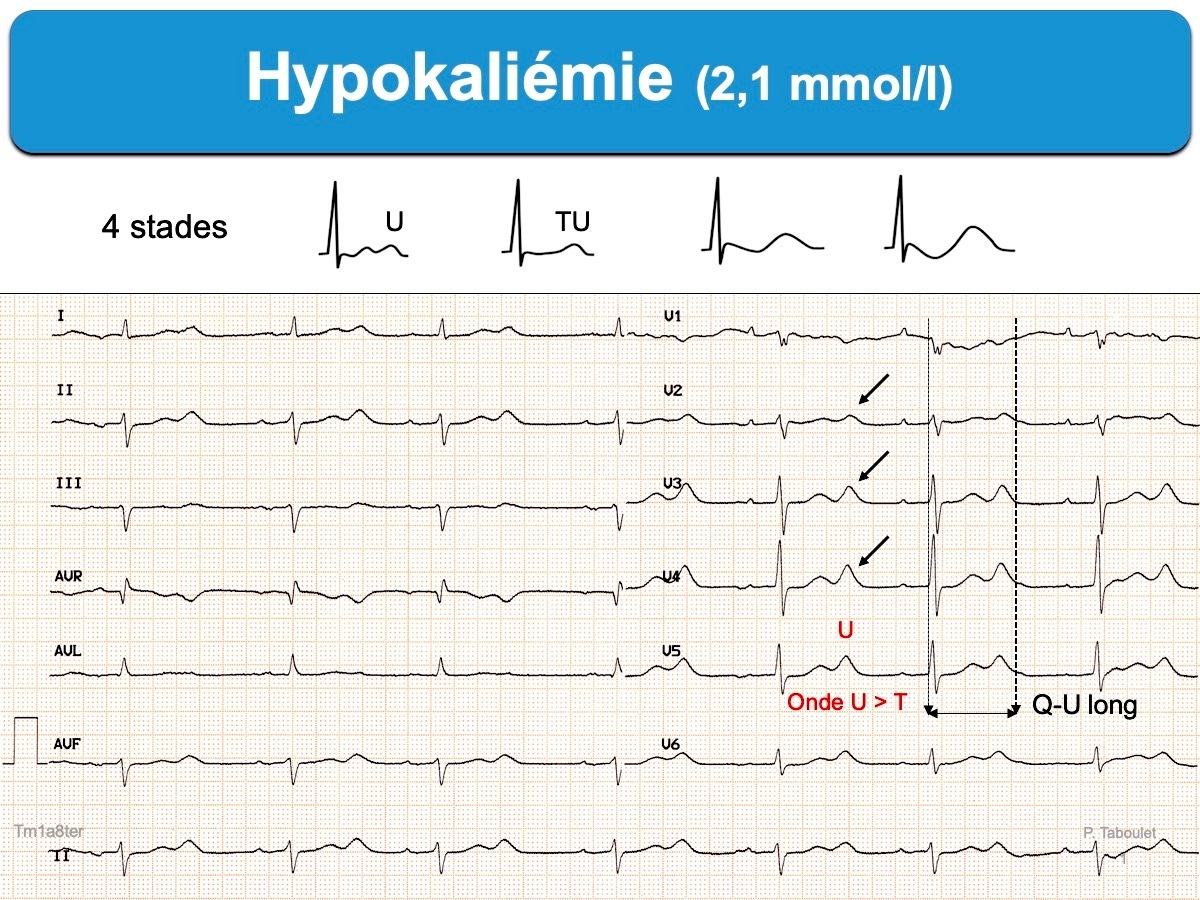 Cours n°2 - Electrocardiogramme (ECG) Vwc0