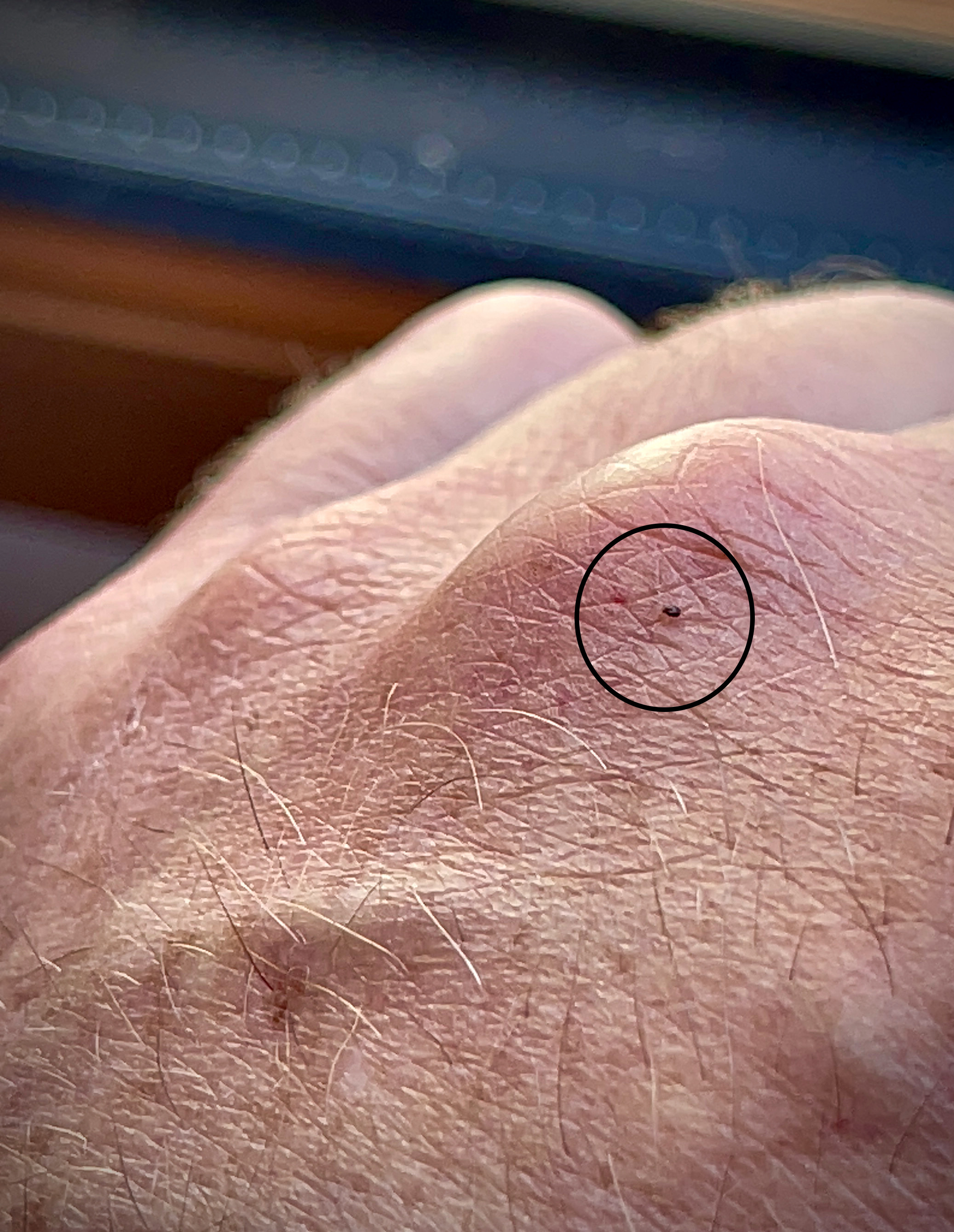 Sensation De Betes Qui Courent Sur La Peau www.notre-planete.info